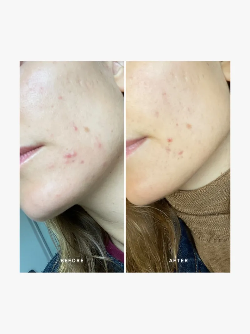 alphah_instant_action_bha_6.webp Alpha-H Instant Action BHA Blemish Treatment | MECCA Best
