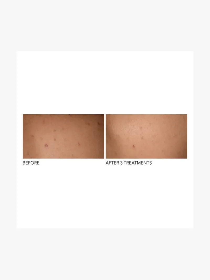 Dr. Dennis Gross Dr Dennis Gross Alpha Beta Exfoliating Body Treatment | MECCA Hot