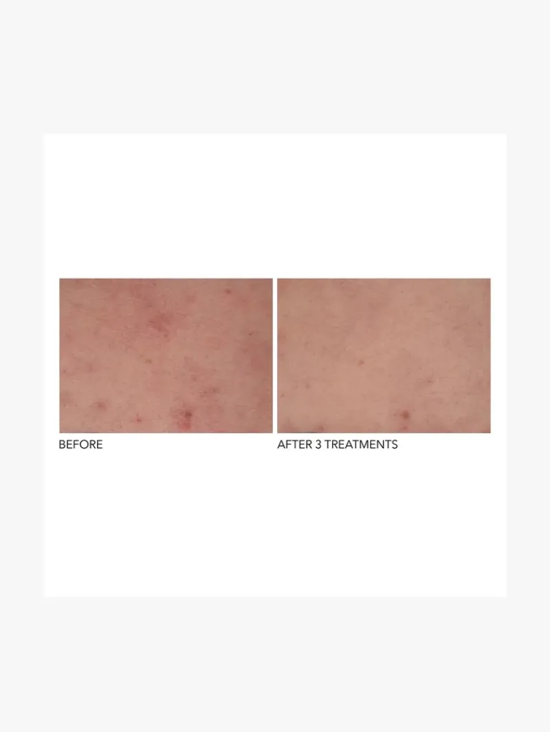 dr_dennis_gross_alpha_bet_2-1.webp Dr. Dennis Gross Dr Dennis Gross Alpha Beta Exfoliating Body Treatment | MECCA Hot