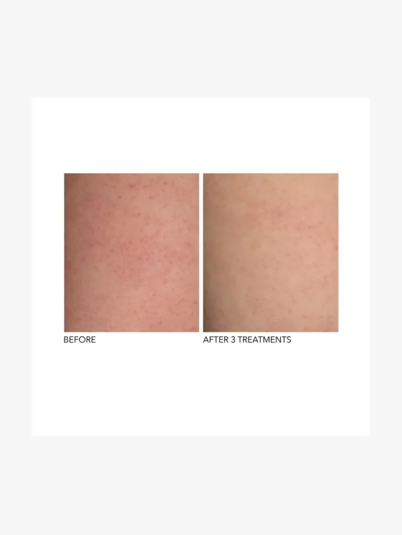 dr_dennis_gross_alpha_bet_3-1.webp Dr. Dennis Gross Dr Dennis Gross Alpha Beta Exfoliating Body Treatment | MECCA Hot