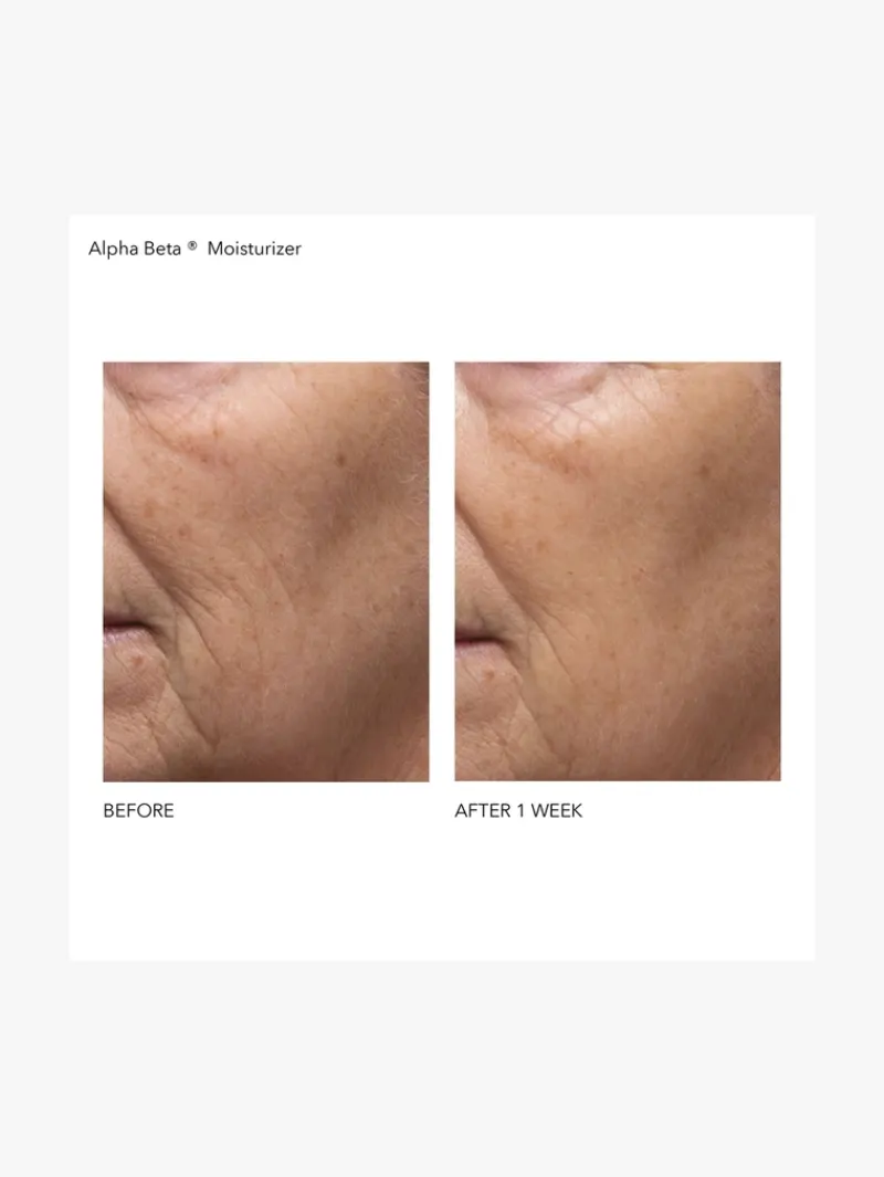 dr_dennis_gross_alpha_bet_5.webp Dr. Dennis Gross Dr Dennis Gross Alpha Beta Daily Moisturizer | MECCA Clearance