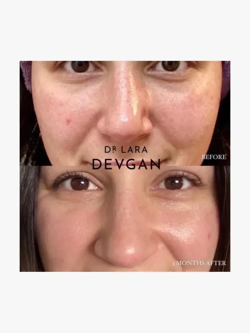 dr_lara_devgan_x_concentr_5-1.webp Dr. Lara Devgan 10x Concentration Retinol Bakuchiol Serum | MECCA Sale