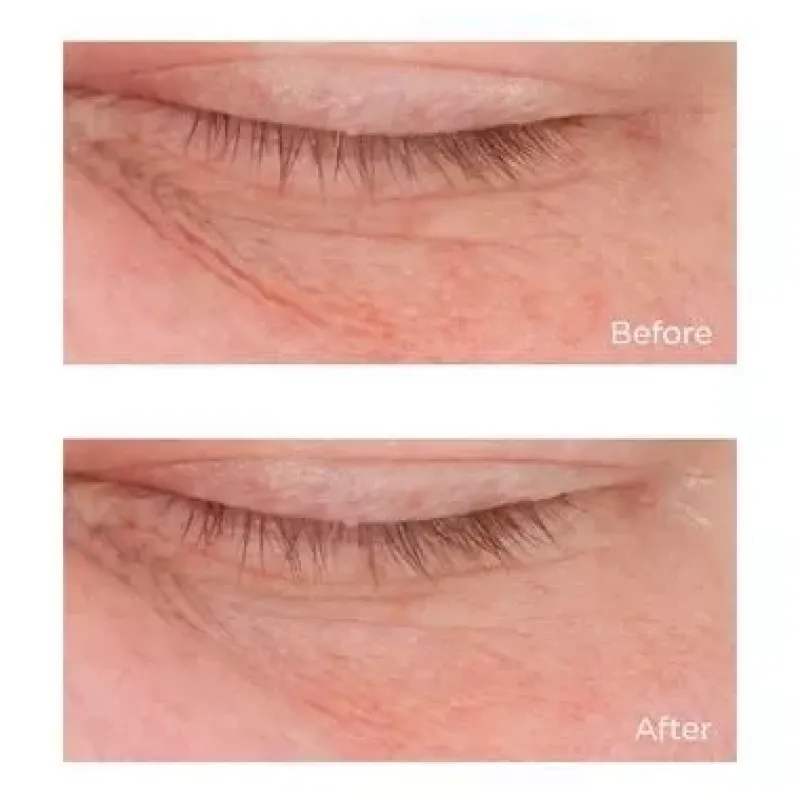 perricone_md_cold_plasma__3-4.webp Perricone MD Cold Plasma+ Eye | MECCA Fashion
